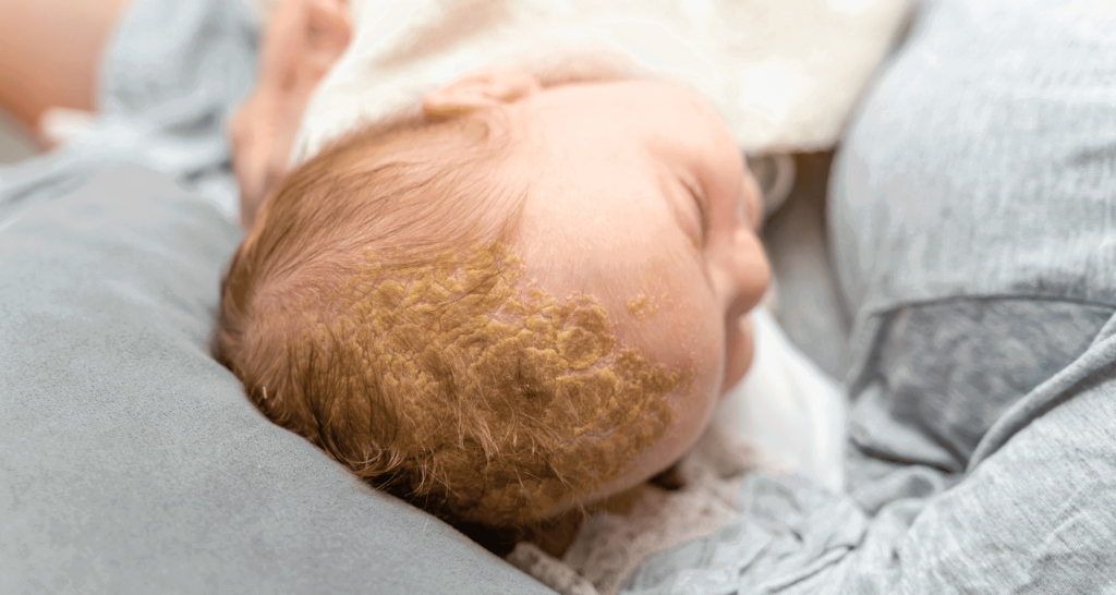 6. "Blonde Hair Newborn Baby" - Natural Remedies for Cradle Cap - wide 9